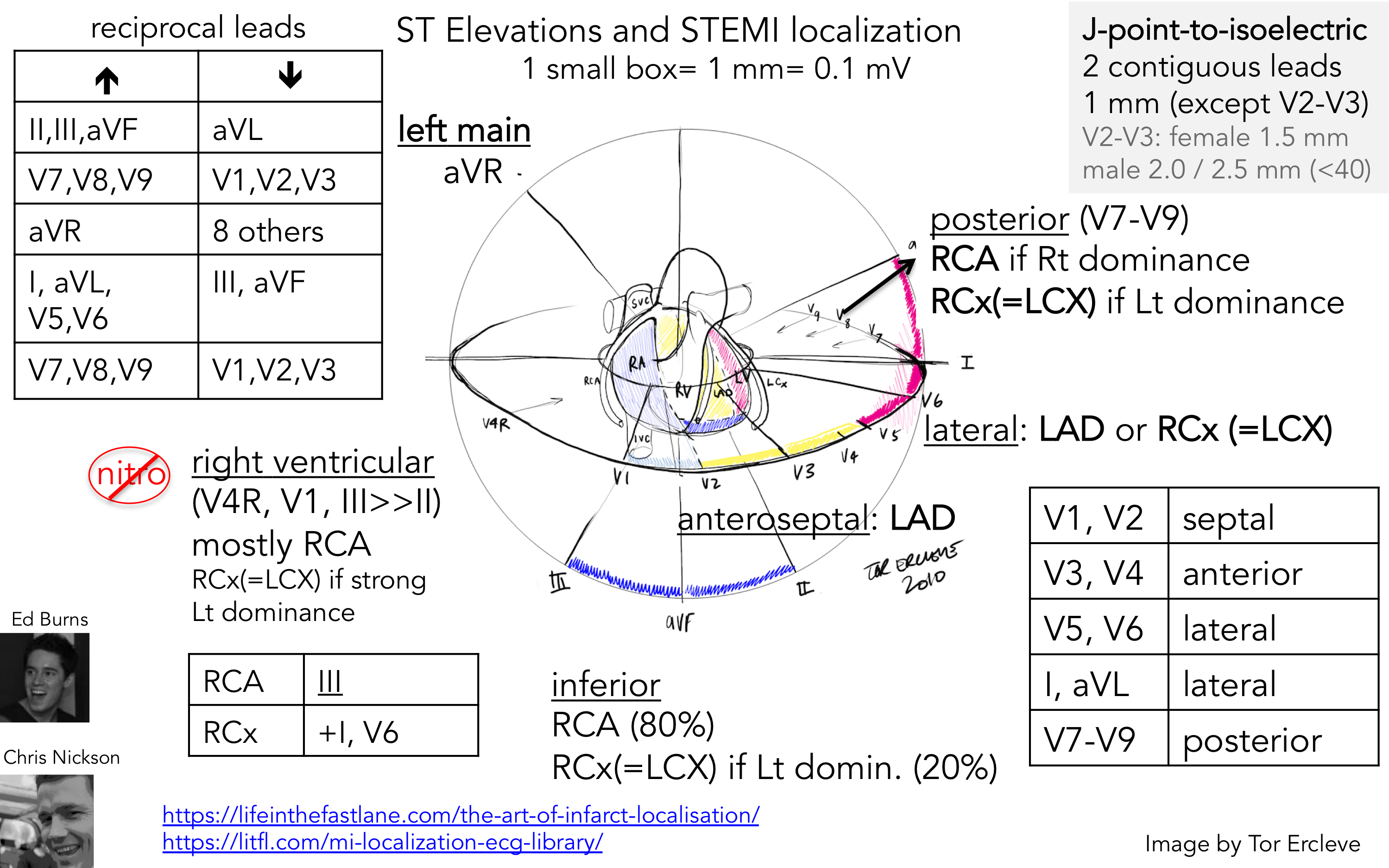 STEMI localisation PNG.png