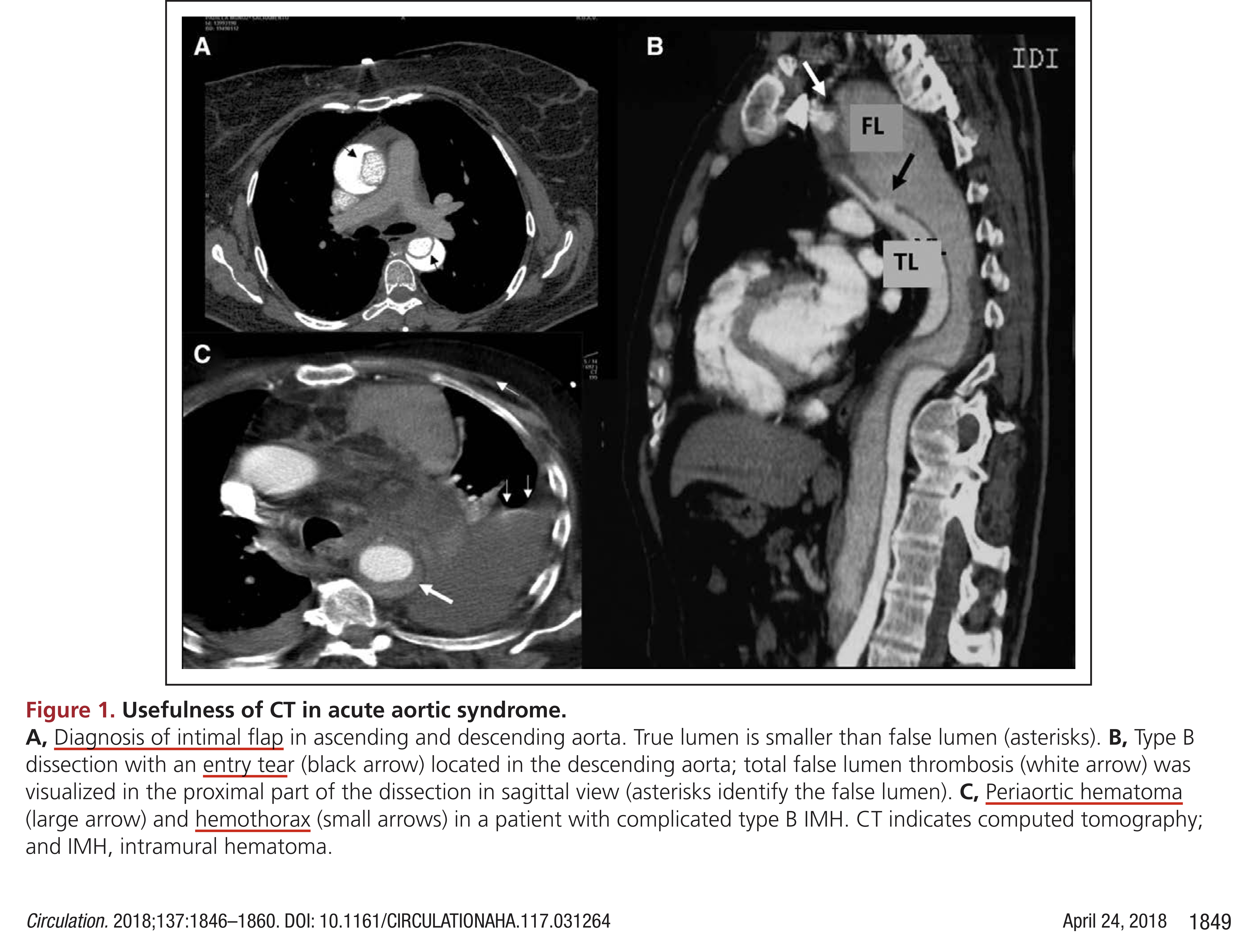 Usefulness of CT in AoD IRAD 18.jpg