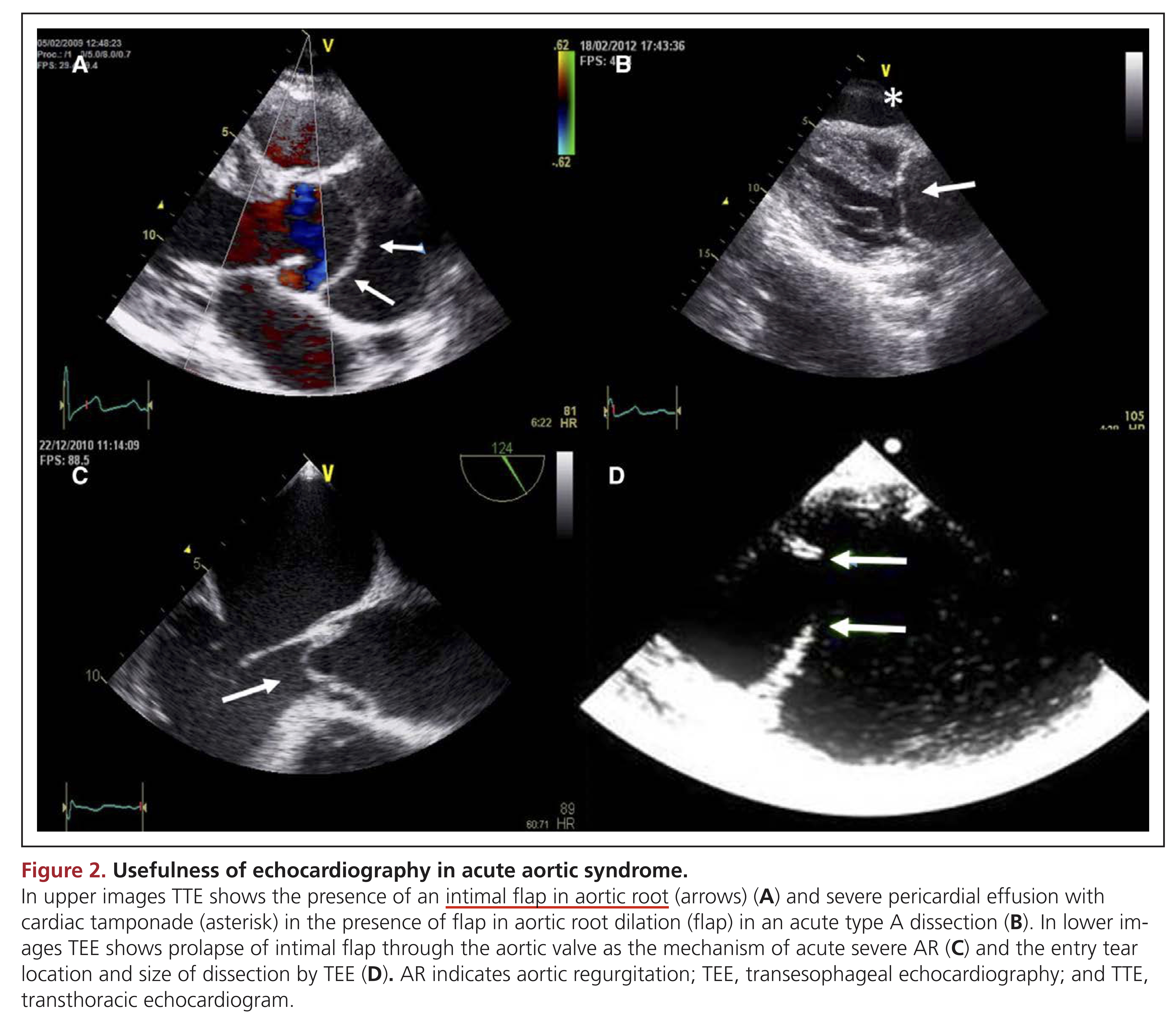 Usefulness of TTE and TEE in AoD IRAD 18.jpg