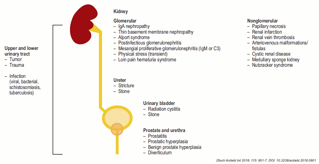 hematuria etiology Dtsch Arztebl Int 2018.png